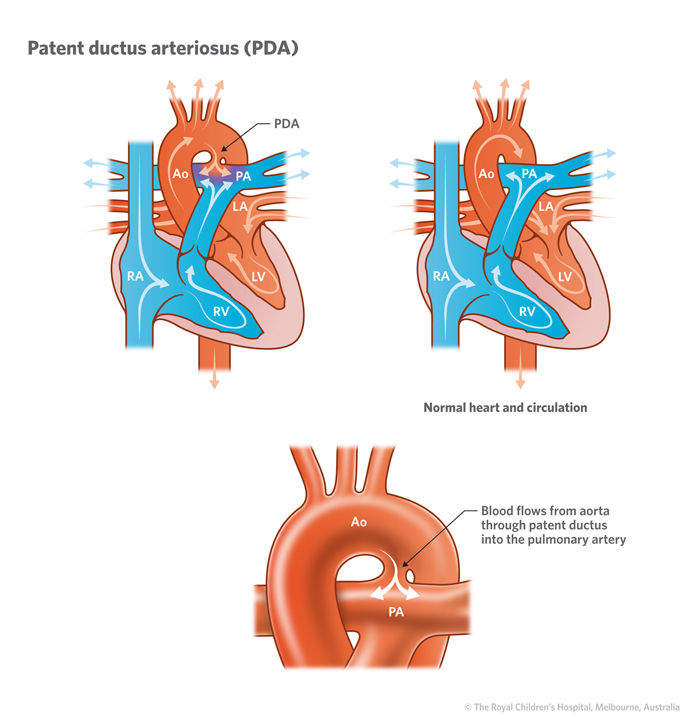 13a_Patent_ductus_arteriosus_PDA