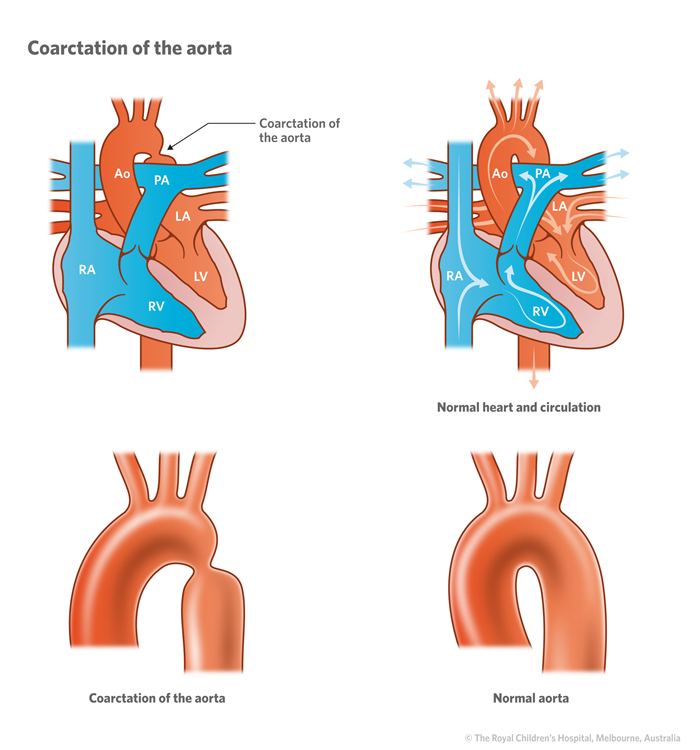 Cardiology Coarctation Of The Aorta