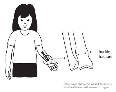 Fracture care: buckle fracture