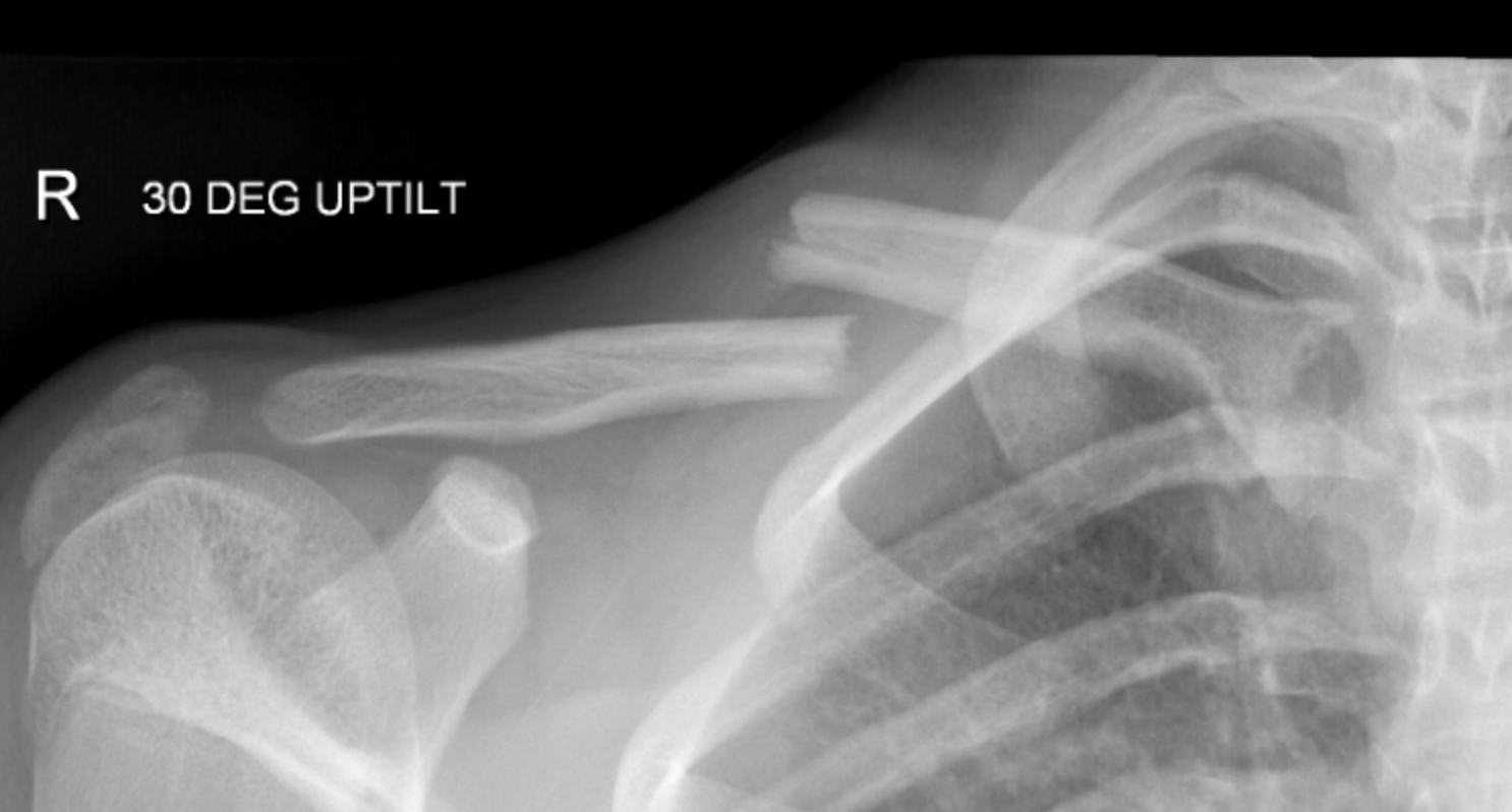 broken collarbone x ray