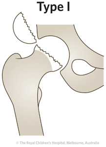 Clinical Practice Guidelines : Neck of femur - Emergency Department