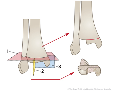types of fibular fractures