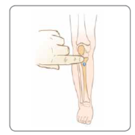 Proximal tibia