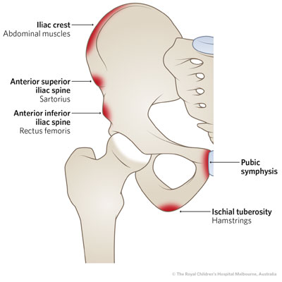 Iliac crest apophyseal avulsion fracture