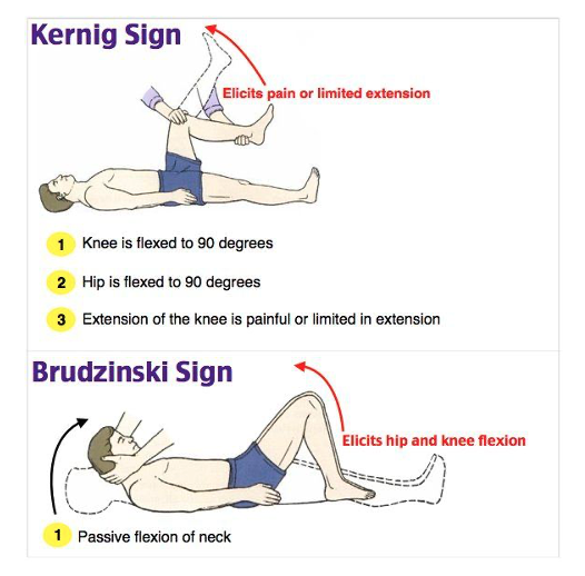 Brudzinski sign