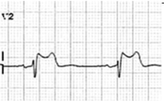 Clinical Practice Guidelines : Basic Paediatric ECG interpretation