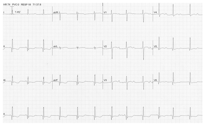 ECG-ST