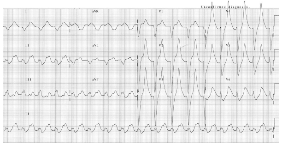 ECG: prolonged PR interval, broad bizarre QRS complexes, peaked T waves