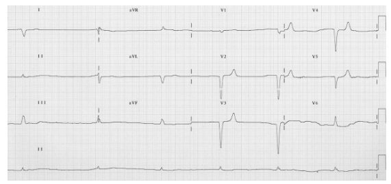 ECG: bradyarrhythmia, slow junctional rhythm, peaked T waves