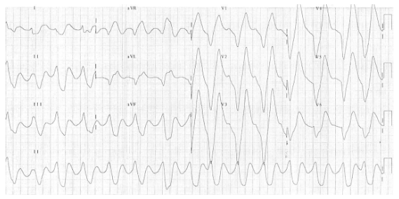 ECG: huge, peaked T waves, sine wave appearance 