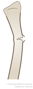 Clinical Practice Guidelines : Radius - ulna shaft ...