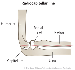 Clinical Practice Guidelines : Monteggia fracture-dislocations ...