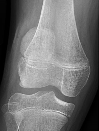 knee patellar dislocation x ray