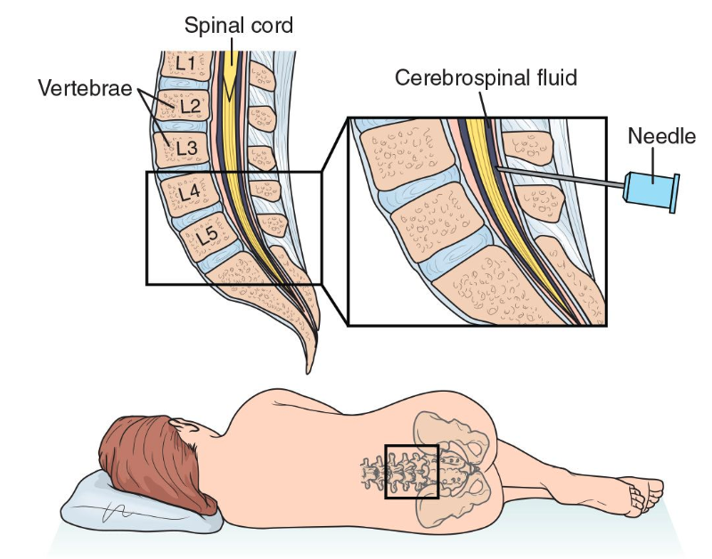 Spinal-insertion-point