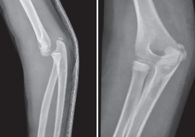 elbow dislocation classification
