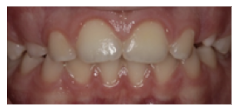 mixed-dentition