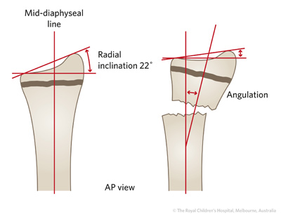 Fracture Education : Evaluation