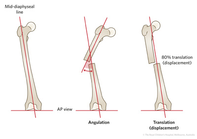 Fracture Education Evaluation