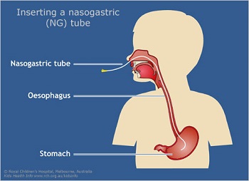 Kids Health Information Nasogastric Tubes