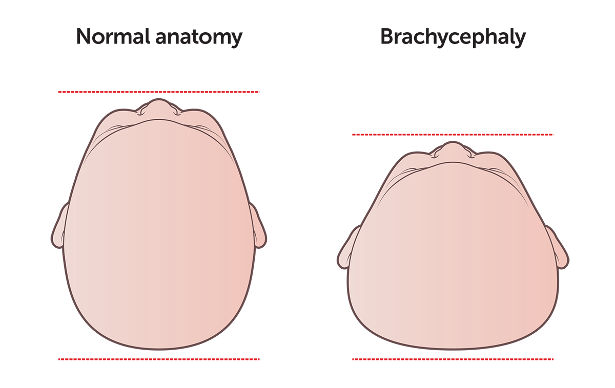 Medical illustration showing two babies' heads. The head on the left is normal, while the head on the right has brachycephaly; it is misshapen and appears flat at the back.