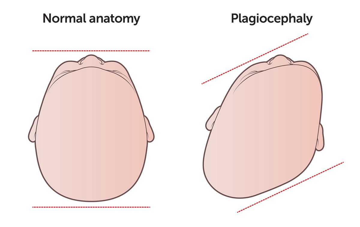 Medical illustration showing two babies' heads. The head on the left is normal, while the head on the right has plagiocephaly; it is misshapen and appears uneven.