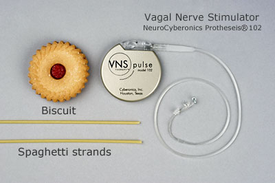 DIY Transcutaneous Vagus Nerve Stimulator : 5 Steps - Instructables