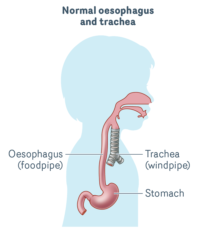 Transition Support Service Oesophageal Atresia And Tracheo
