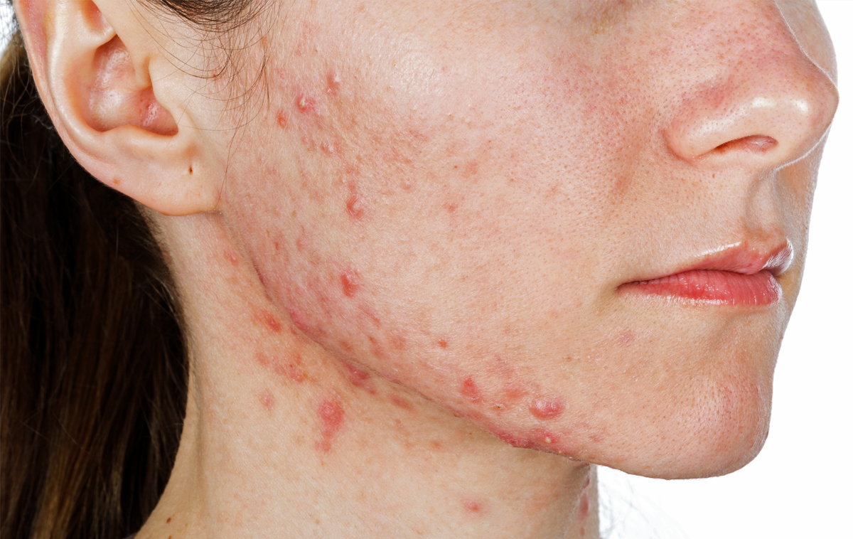 White female teen with cystic acne White female teen with cystic acne
