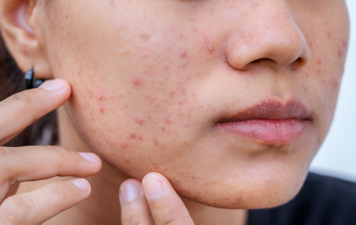 Asian female teen with acne Asian female teen with acne